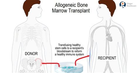 bone marrow transplant pcso|Bone marrow transplant: What it is, uses, risks, and .